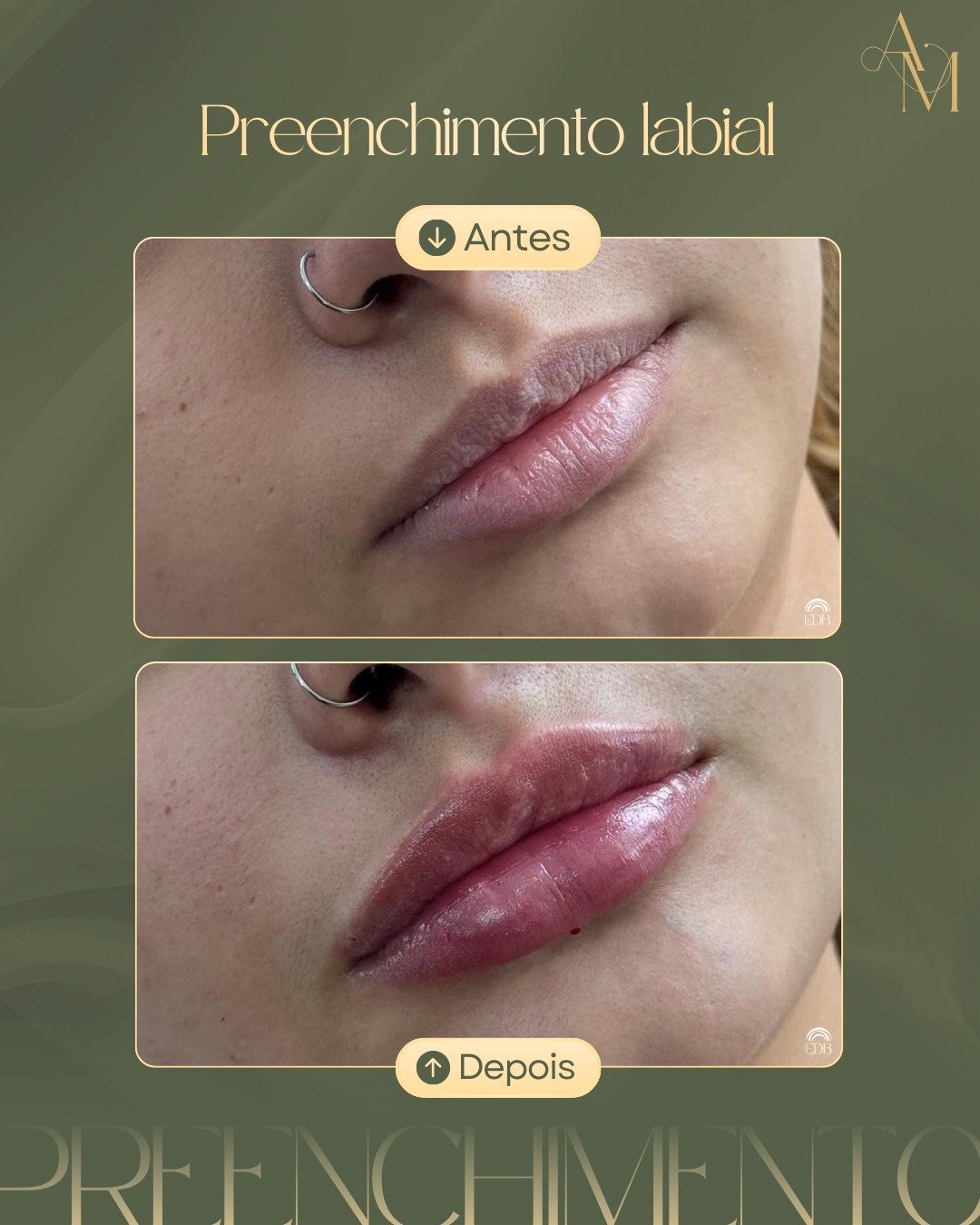 Resultado de harmonização labial