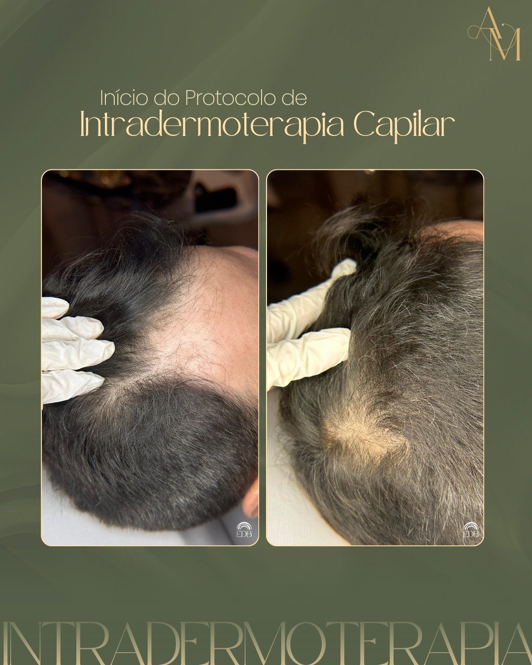 Protocolo de intradermoterapia capilar
